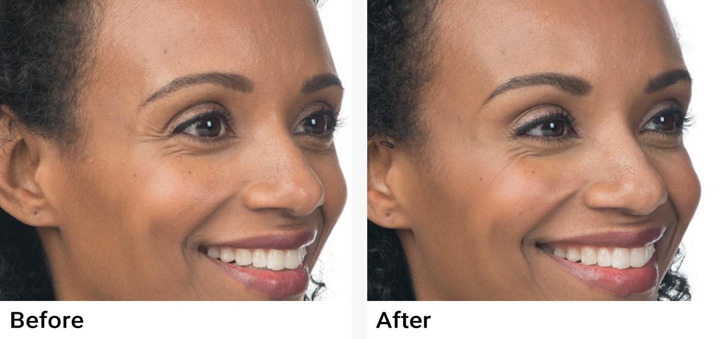 BOTOX® Before & After Examples