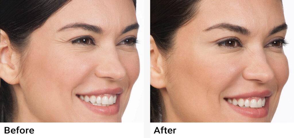 BOTOX® Before & After Examples