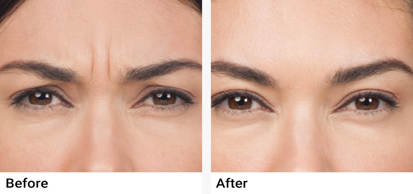 BOTOX® Before & After Examples