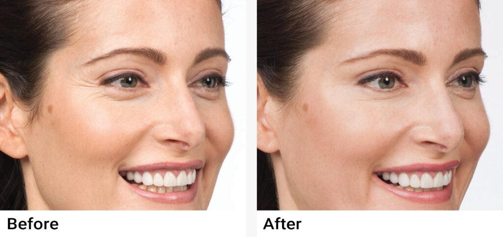 BOTOX® Before & After Examples