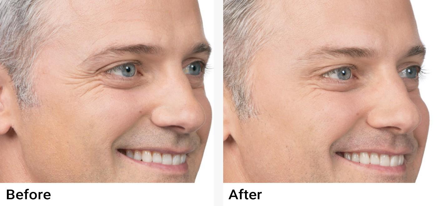 BOTOX® Before & After Examples