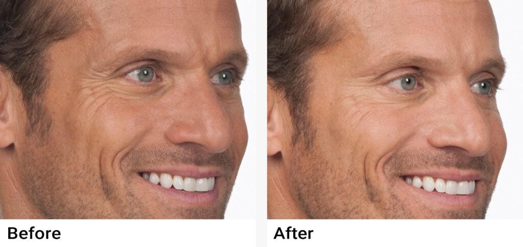 BOTOX® Before & After Examples