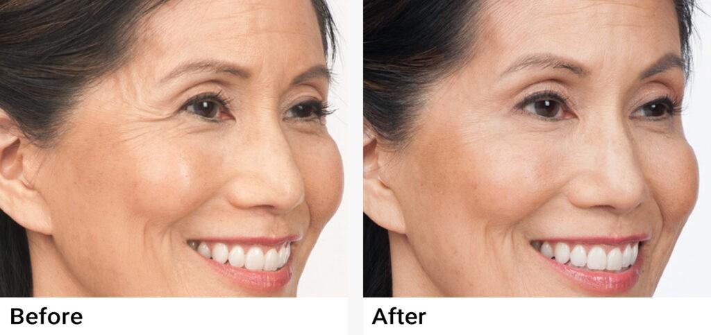 BOTOX® Before & After Examples