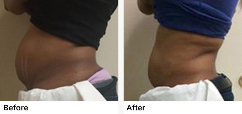 CoolSculpting® Before & After Examples