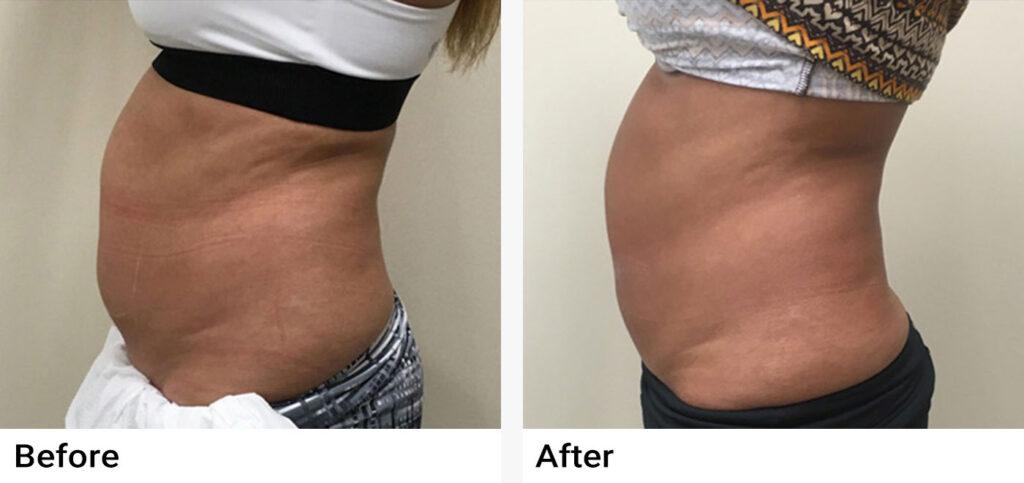 CoolSculpting® Before & After Examples