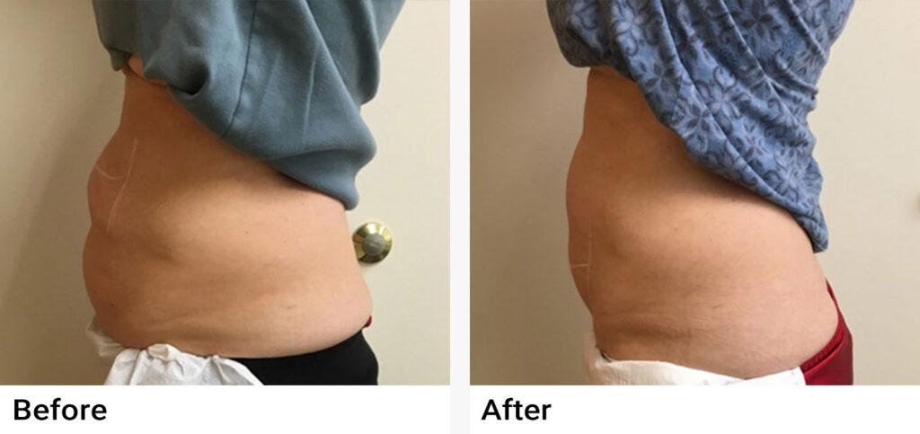 CoolSculpting® Before & After Examples