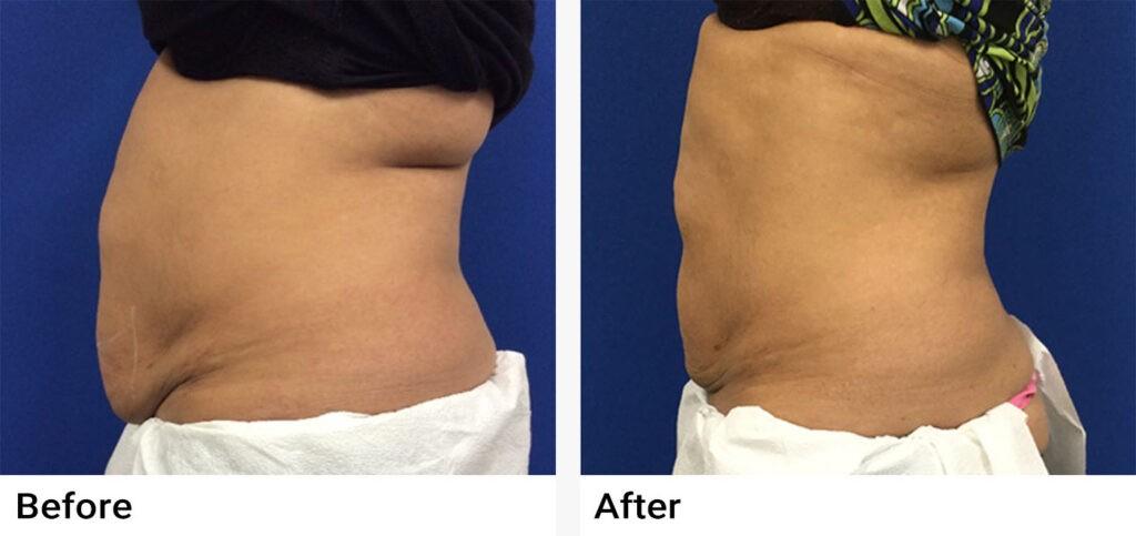 CoolSculpting® Before & After Examples