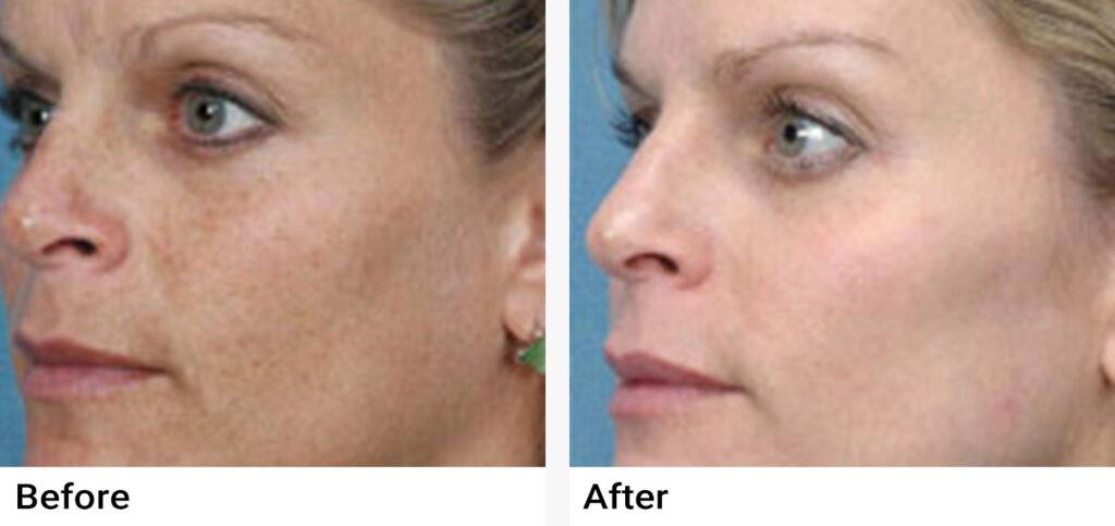 eMatrix™ Sublative Rejuvenation Before & After Examples