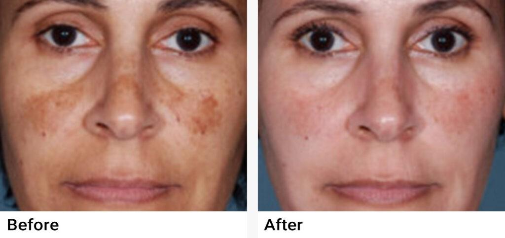 eMatrix™ Sublative Rejuvenation Before & After Examples