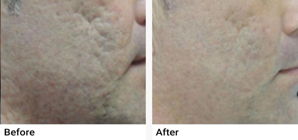 eMatrix™ Sublative Rejuvenation Before & After Examples