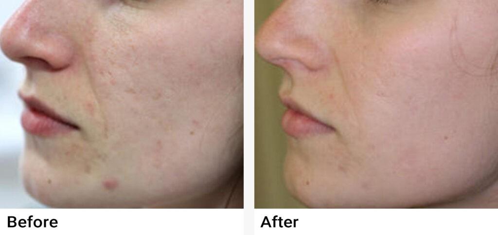 eMatrix™ Sublative Rejuvenation Before & After Examples