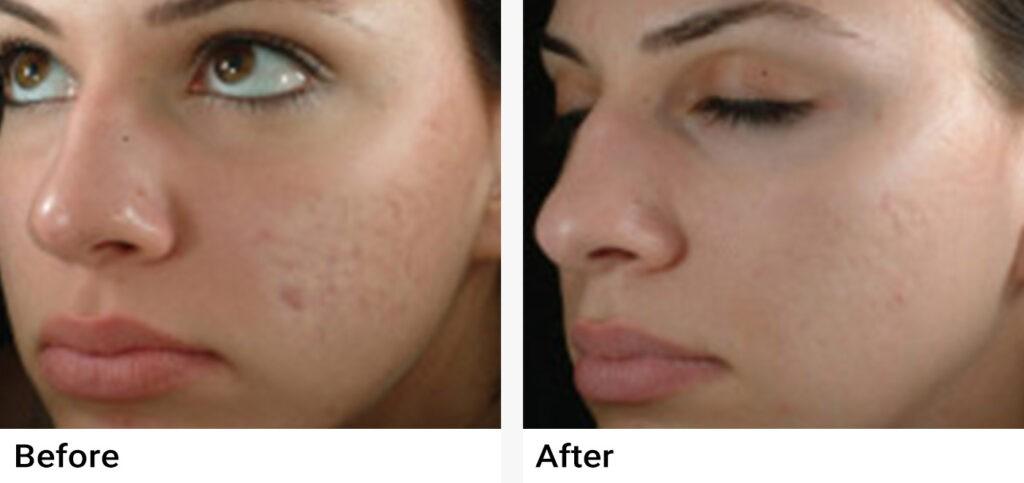 eMatrix™ Sublative Rejuvenation Before & After Examples