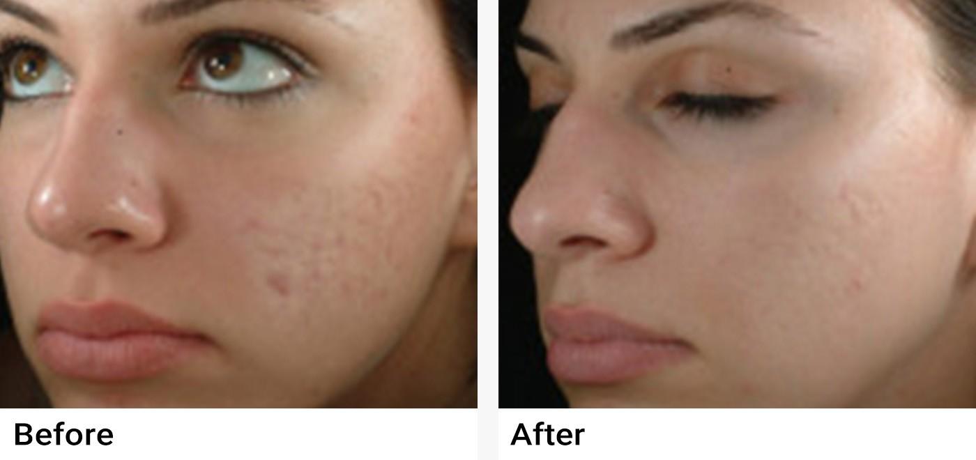 eMatrix™ Sublative Rejuvenation Before & After Examples