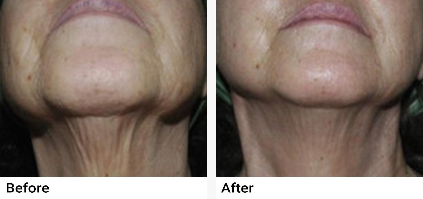 eMatrix™ Sublative Rejuvenation Before & After Examples