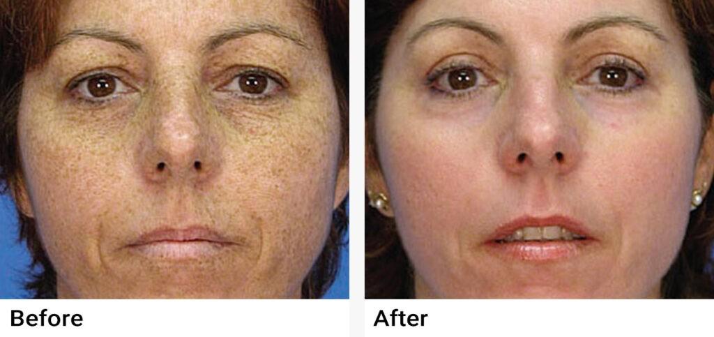 IPL Photofacial Before & After Examples