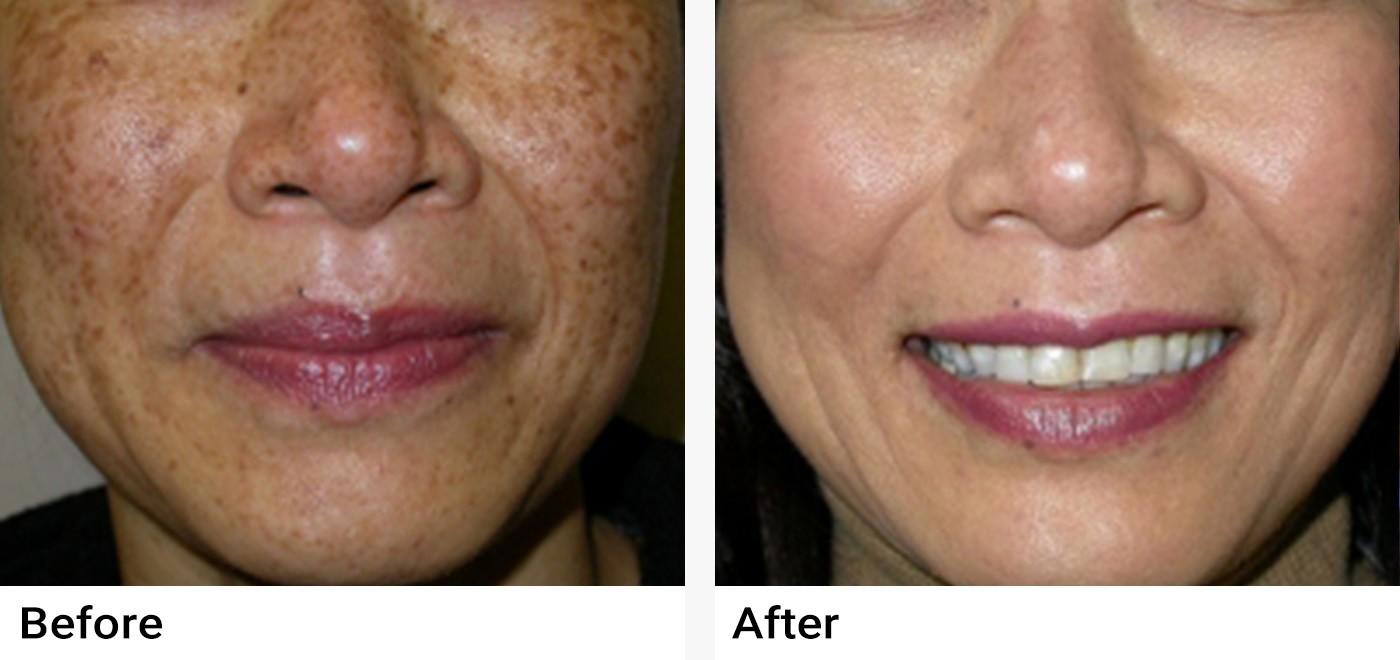 IPL Photofacial Before & After Examples