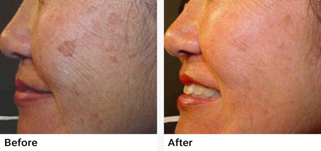 IPL Photofacial Before & After Examples