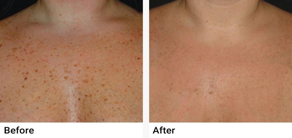 IPL Photofacial Before & After Examples