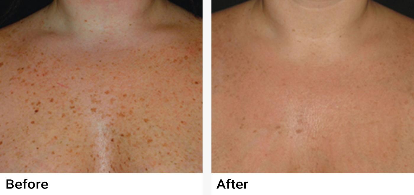 IPL Photofacial Before & After Examples