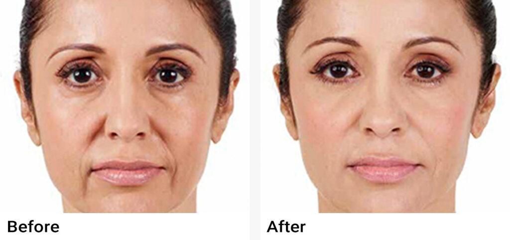 JUVÉDERM® Before & After Examples