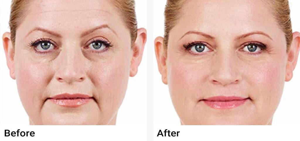 JUVÉDERM® Before & After Examples