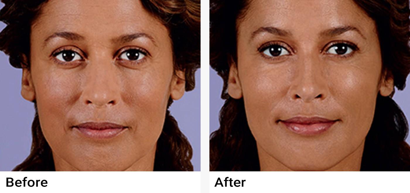 JUVÉDERM® Before & After Examples