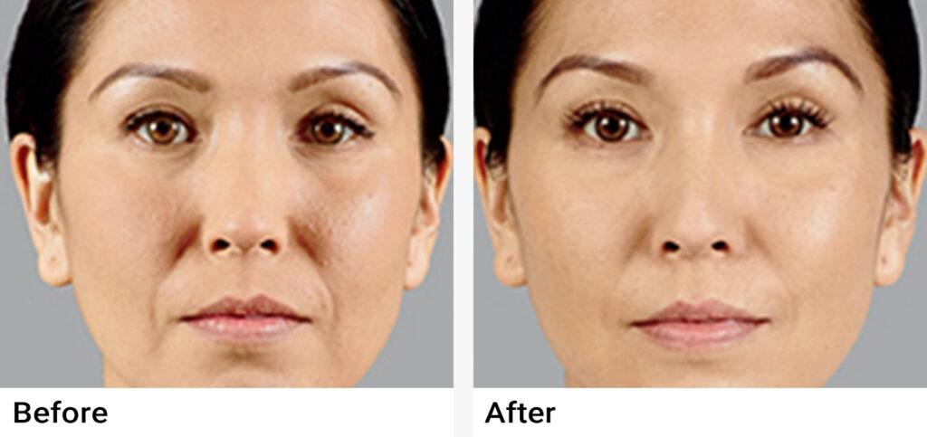 JUVÉDERM® Before & After Examples