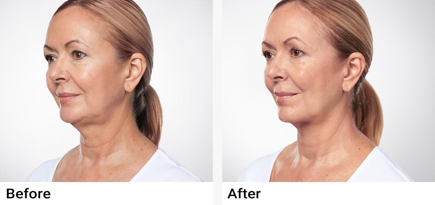 KYBELLA® Before & After Examples