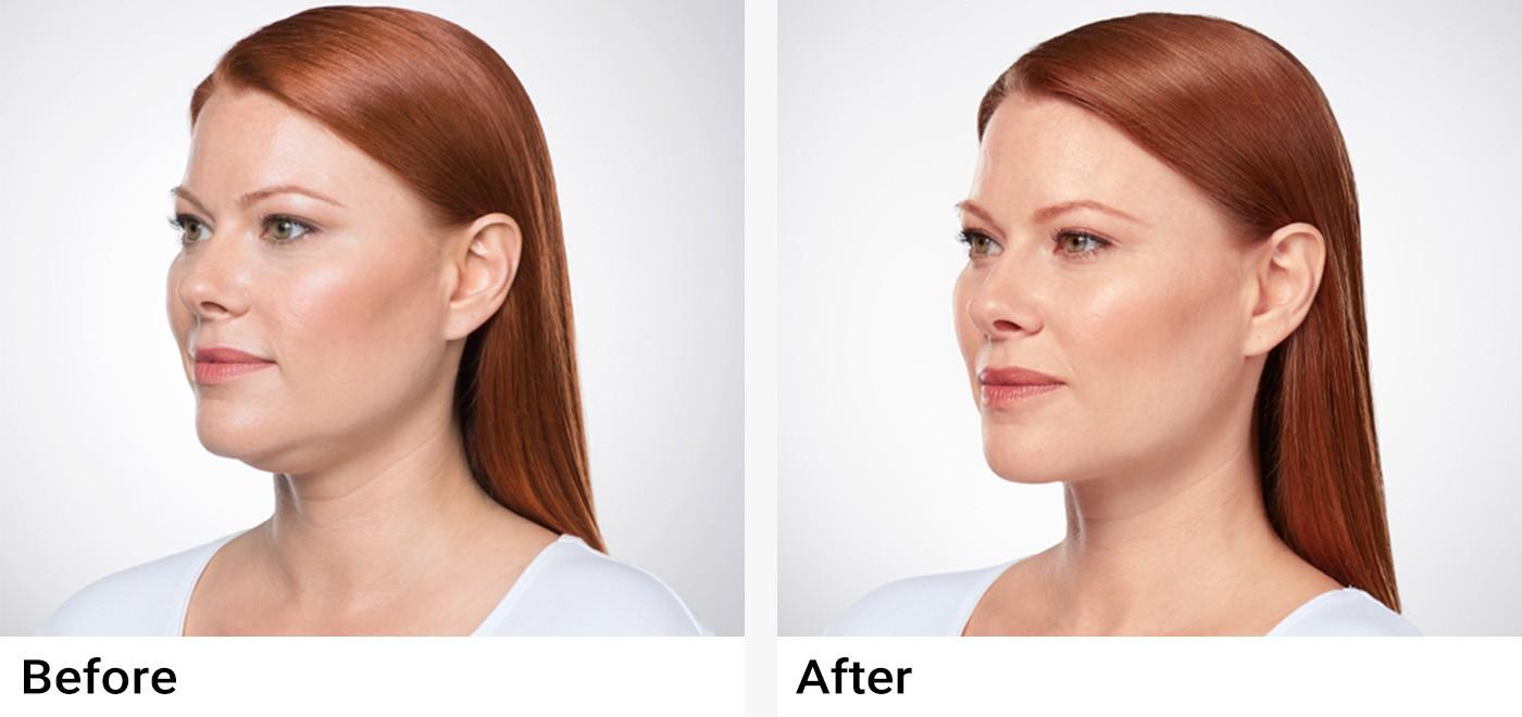 KYBELLA® Before & After Examples