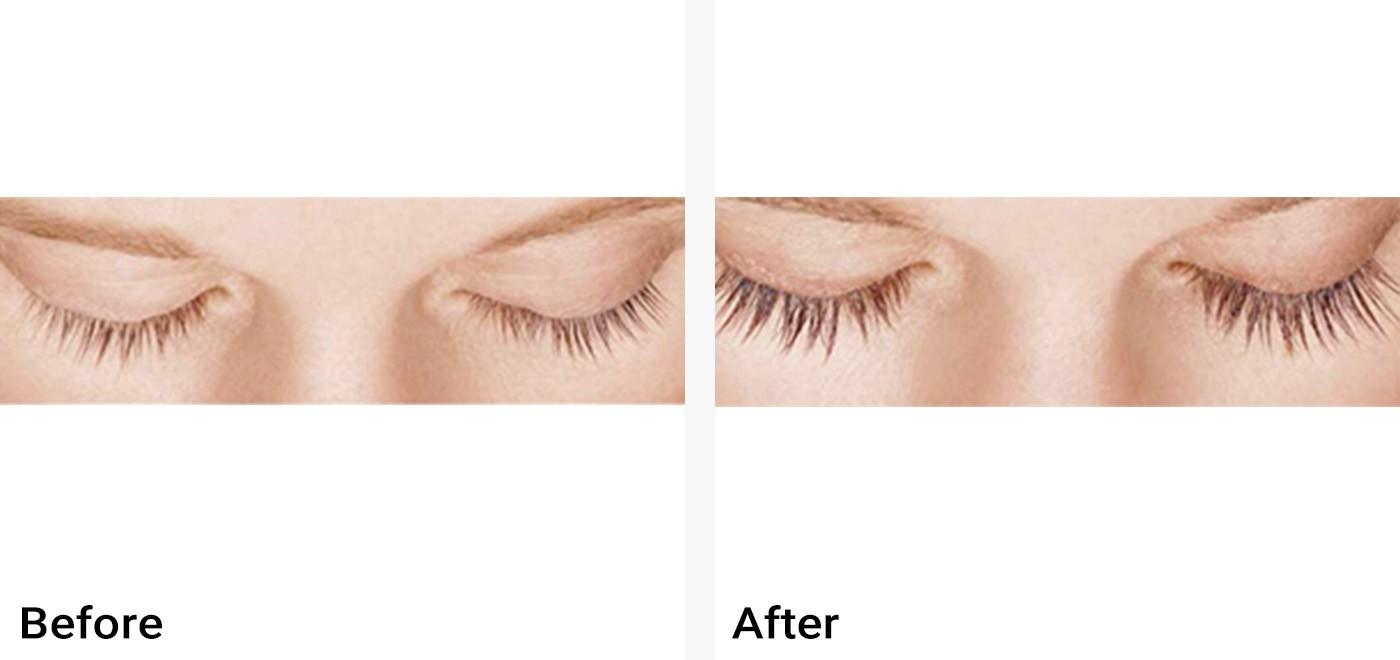 Latisse Before & After Examples