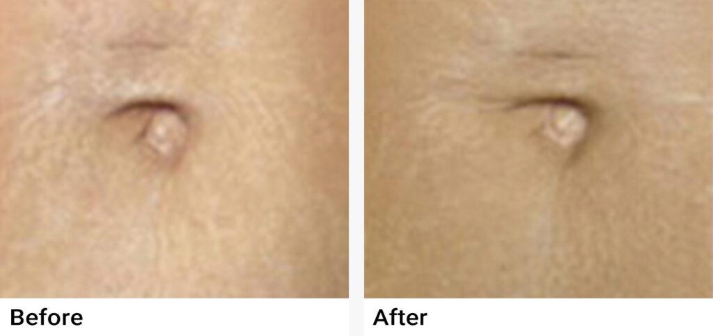 Microneedling Before & After Examples