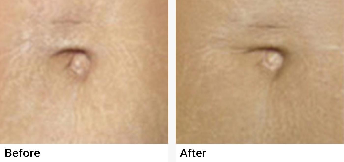 Microneedling Before & After Examples