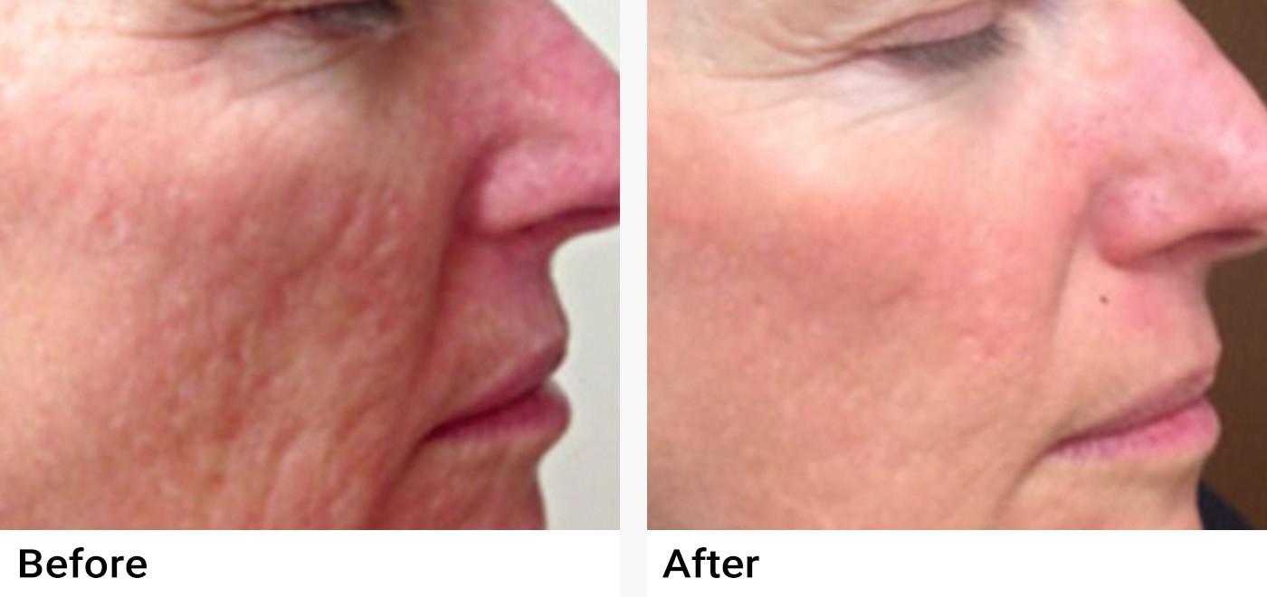 Microneedling Before & After Examples