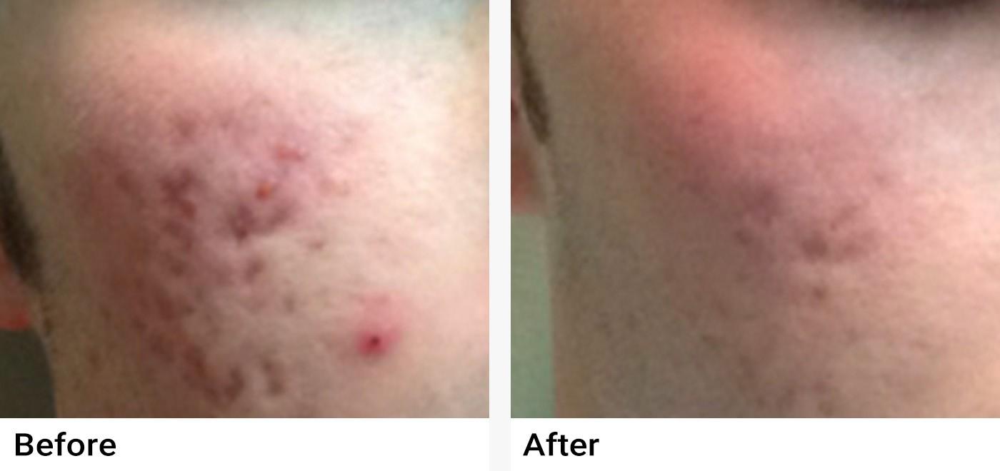 Microneedling Before & After Examples