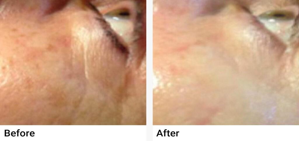 Microneedling Before & After Examples