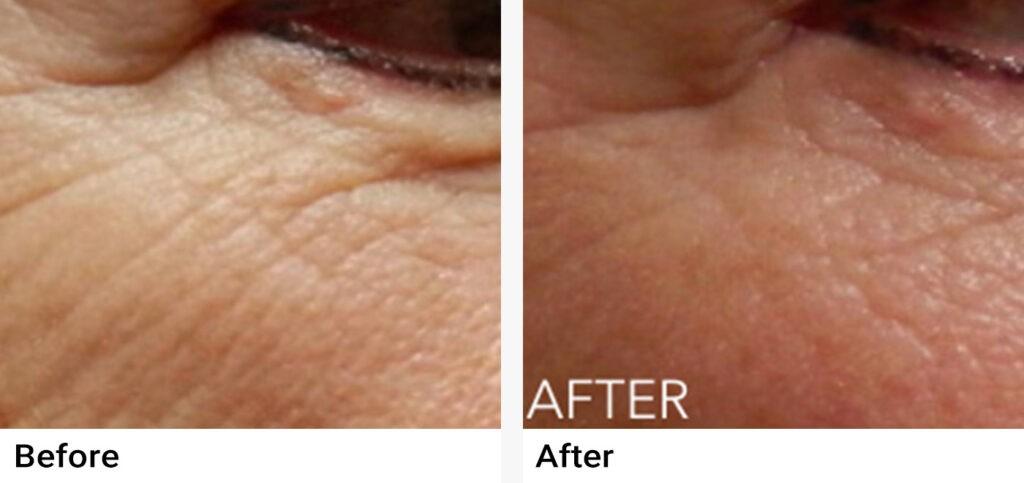 Microneedling Before & After Examples