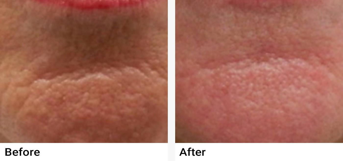 Microneedling Before & After Examples