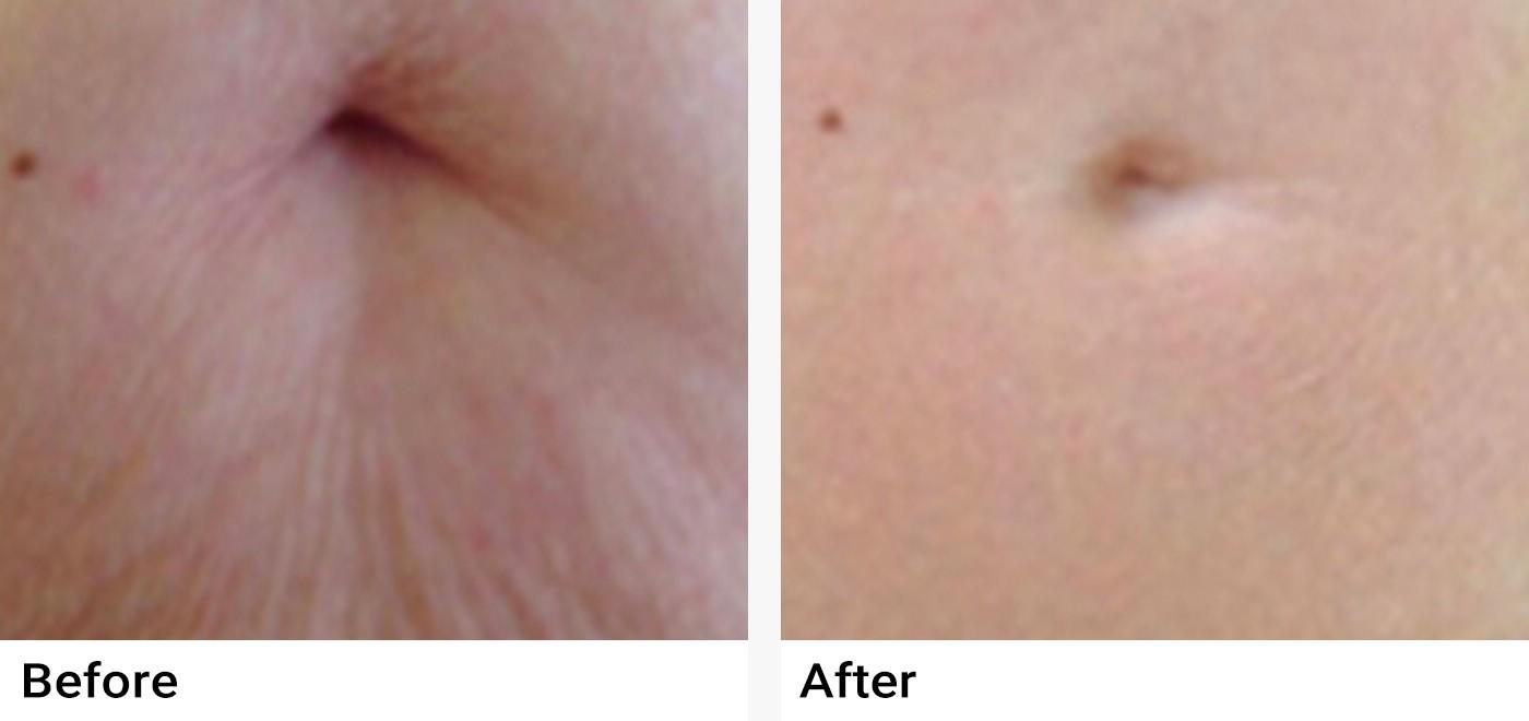 Microneedling Before & After Examples