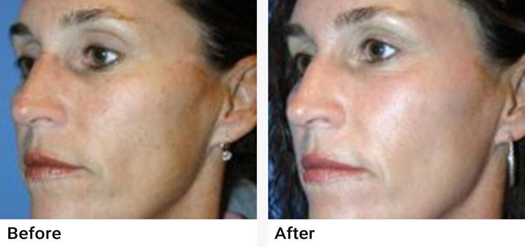 Microneedling Before & After Examples