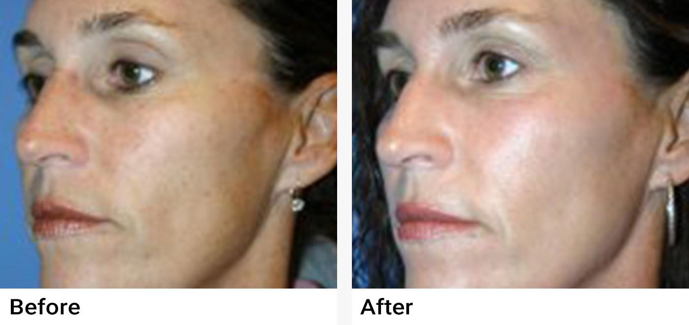 Microneedling Before & After Examples