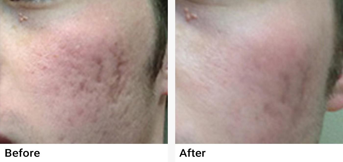 Microneedling Before & After Examples