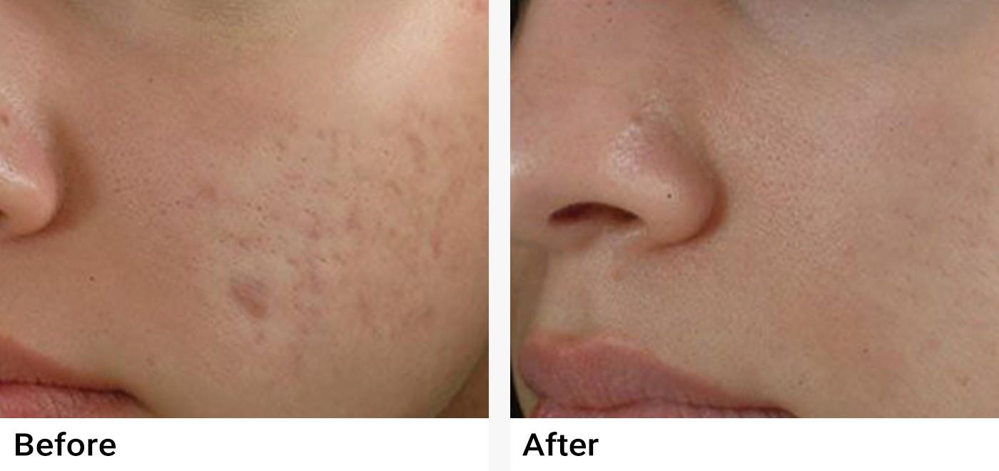 Microneedling Before & After Examples