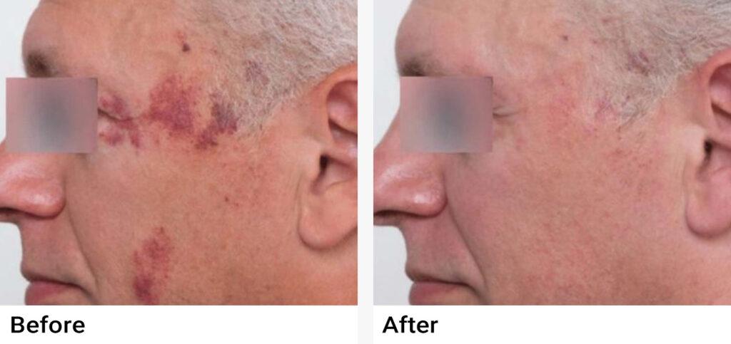 Nordlys™ Aesthetic & Dermatology Before & After Examples