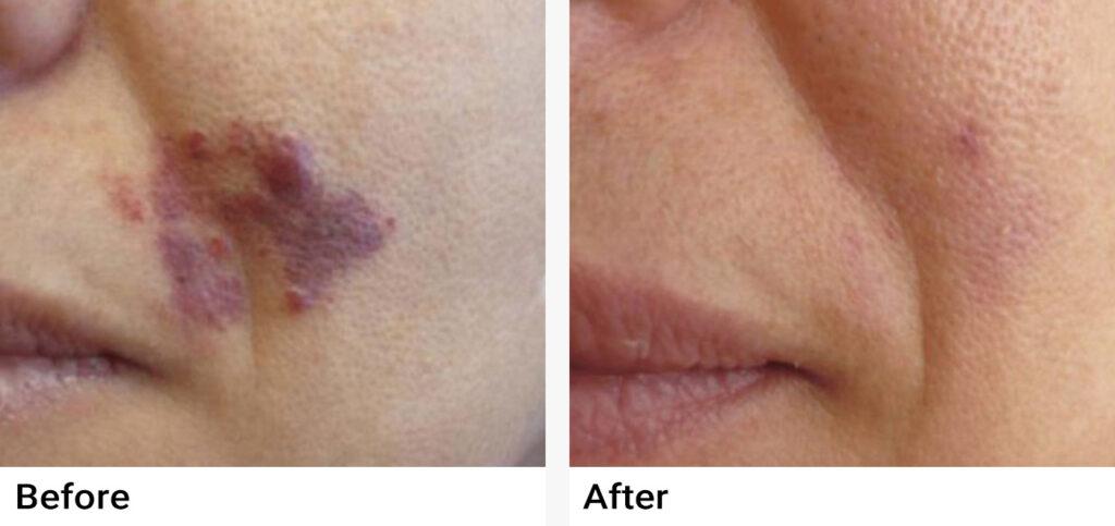 Nordlys™ Aesthetic & Dermatology Before & After Examples