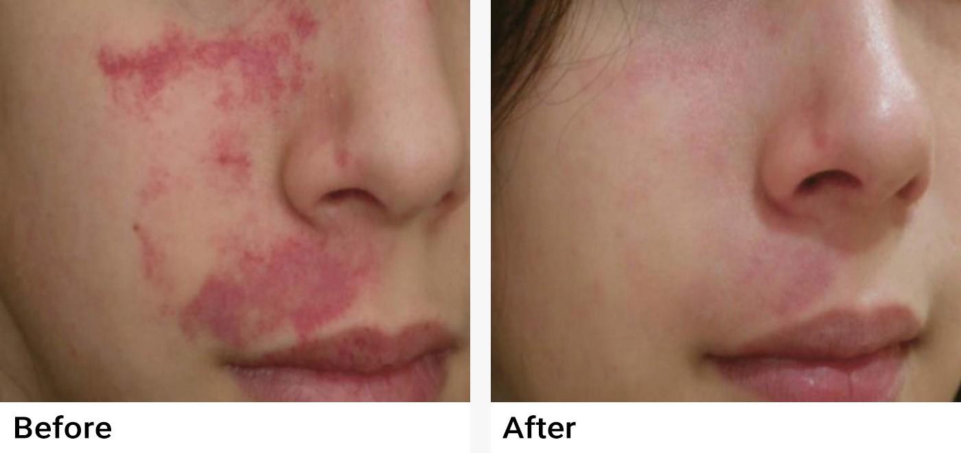 Nordlys™ Aesthetic & Dermatology Before & After Examples