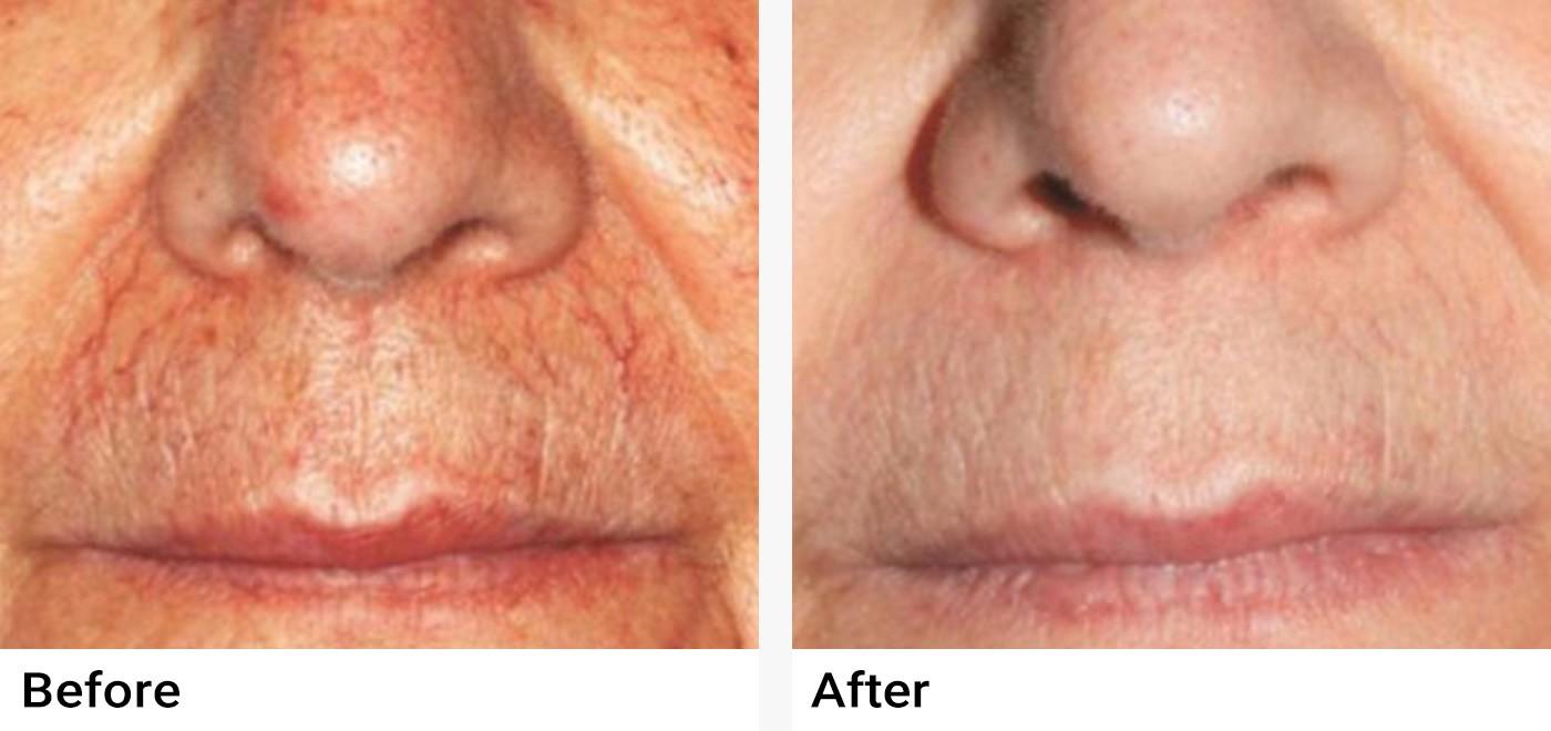 Nordlys™ Aesthetic & Dermatology Before & After Examples