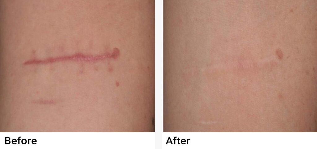 Nordlys™ Aesthetic & Dermatology Before & After Examples