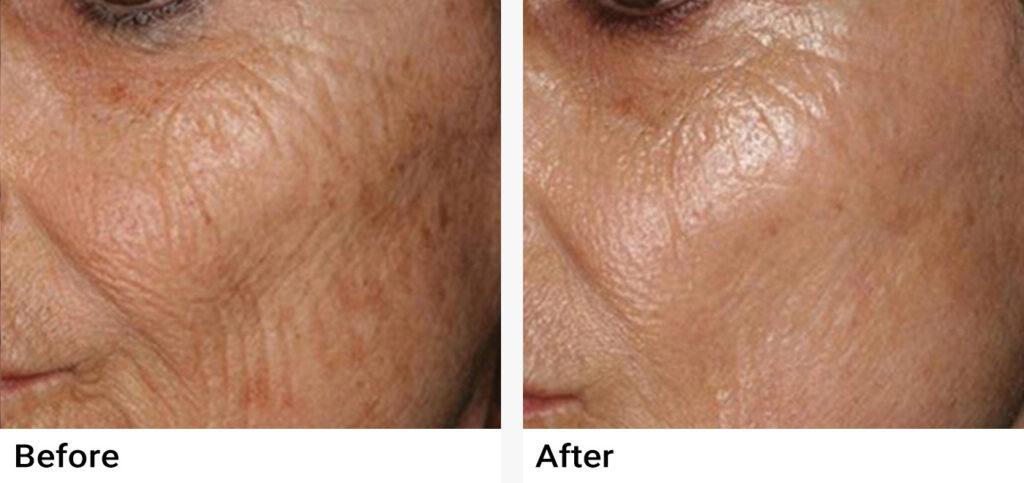 PRP Before & After Examples