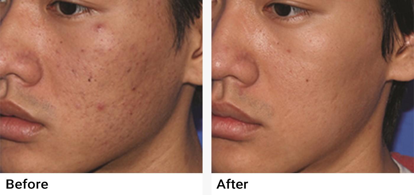 PRP Before & After Examples