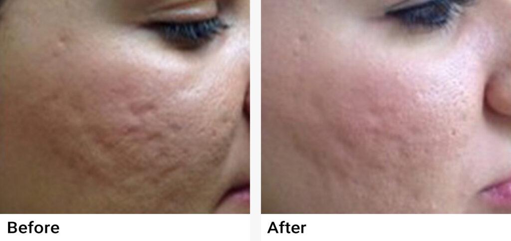 PRP Before & After Examples